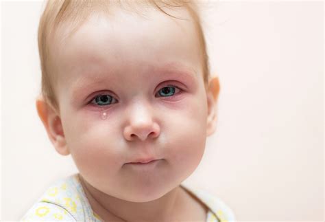 bebeklerde göz altı kızarması neden olur